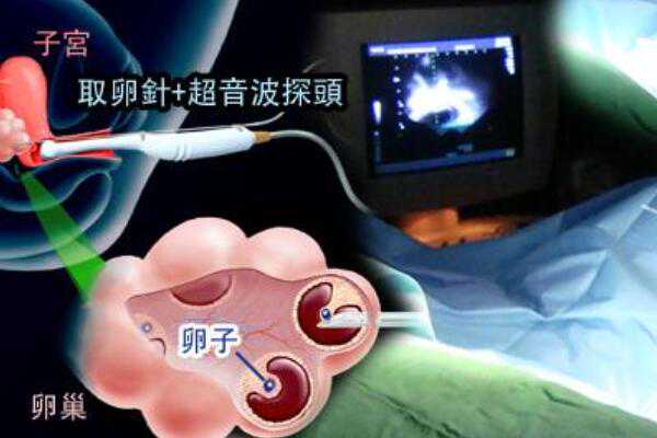 广州2023代孕qq群|龙岩三代试管婴儿成功率什么精索静脉曲张一定要手术吗？导