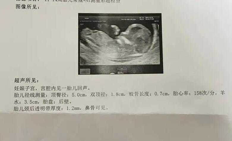广州找大学生捐卵 广州南方医院试管婴儿成功率 ‘孕囊3.8厘米*2.3厘米*3.7厘米